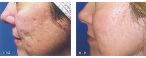 Antes e despois de aplicar o dispositivo láser na pel con cicatrices