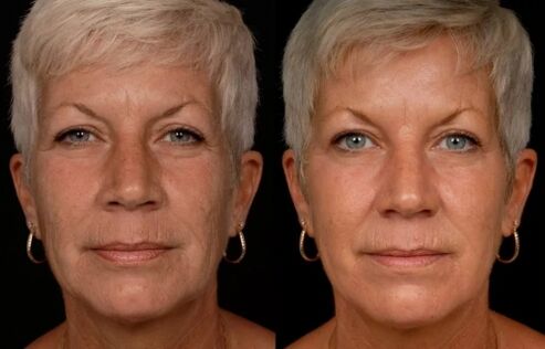 O resultado do tratamento con láser da pel facial - redución das engurras