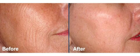 Pel facial antes e despois do procedemento de rexuvenecemento con láser