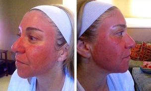 Enrojecemento facial despois do rexuvenecemento con láser